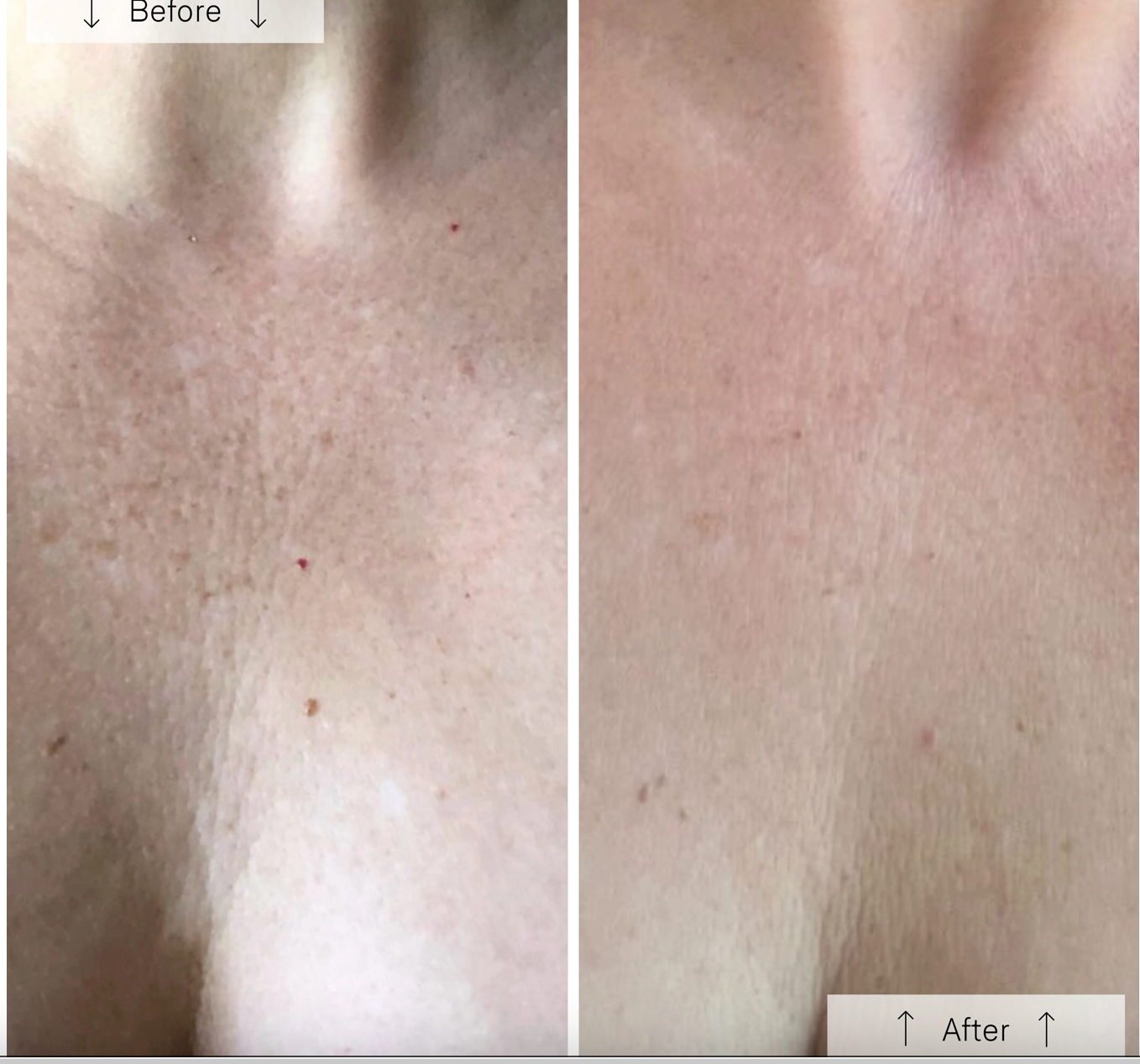 Omnilux Contour Neck & Decollete